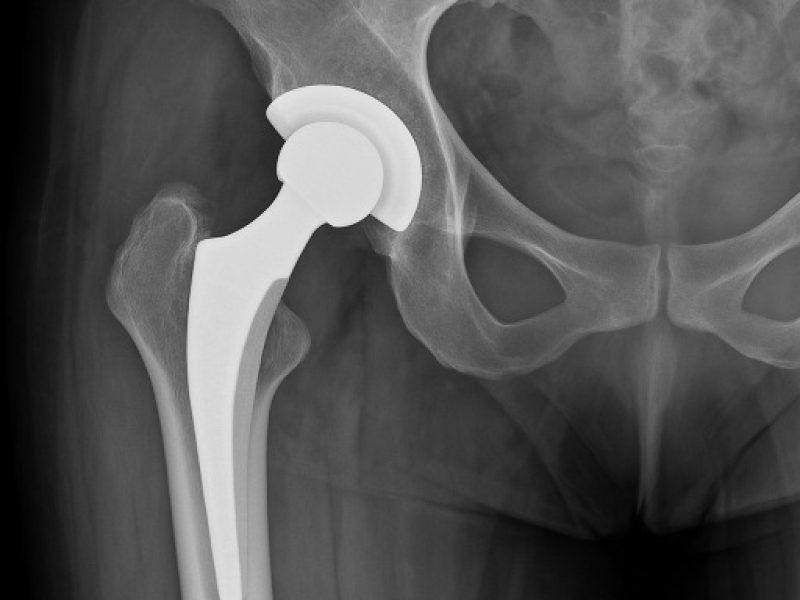 20250628_1456_Hip Arthroplasty X-Ray_simple_compose_01jyv2tbeme3ps3phva2876wr7