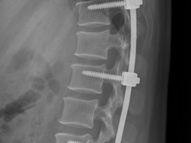 20250628_1534_Spine Fixation X-ray_simple_compose_01jyv4z5r0fxq8n3y3v1ha8qdg